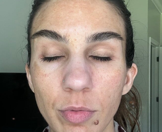 Skin Before VI Precision Peel