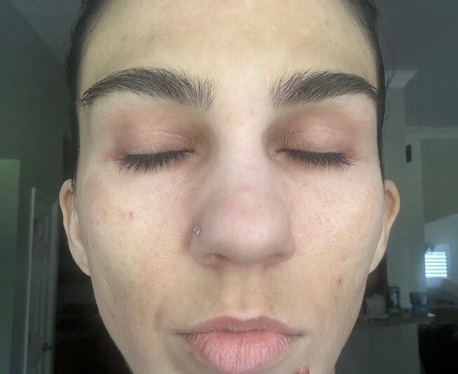 Skin After VI Precision Peel