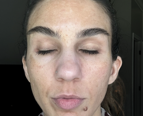 Before VI Precision Peel 